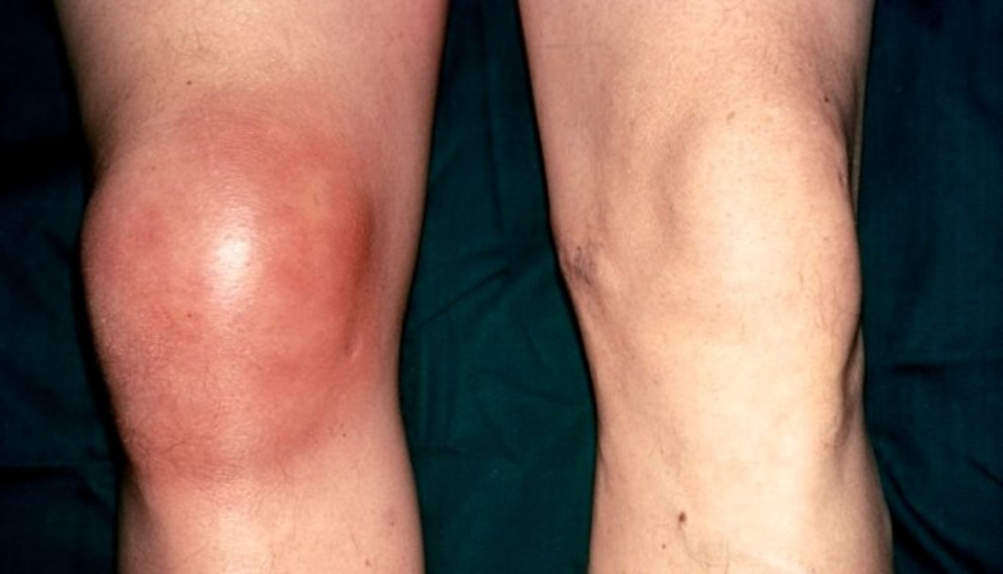 Bệnh Gout khiến khớp gối người bệnh phù nề gây ra những cơn đau dai dẳng không dứt