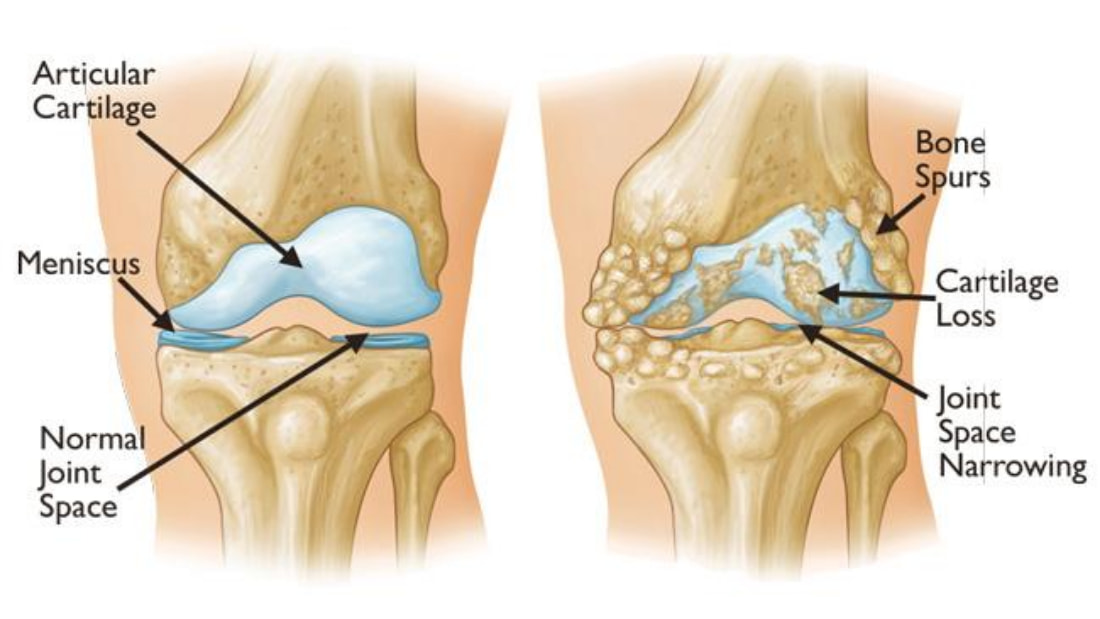 Thoái hoá khớp gối khiến người bệnh khó khăn trong di chuyển thậm chí mất khả năng vận động