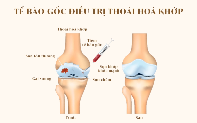 Ví dụ về hiệu quả của tế bào gốc