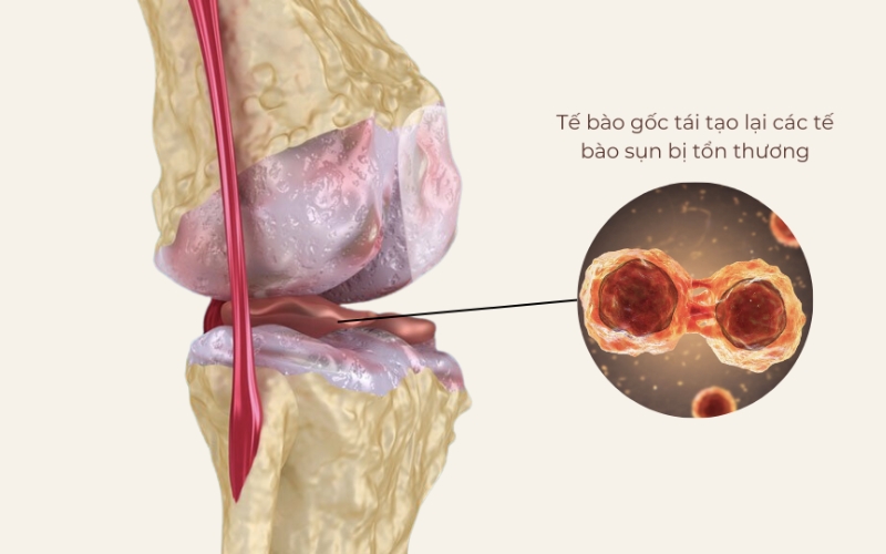 Tế bào gốc sẽ tạo ra và thay thế các tế bào sụn bị tổn thương
