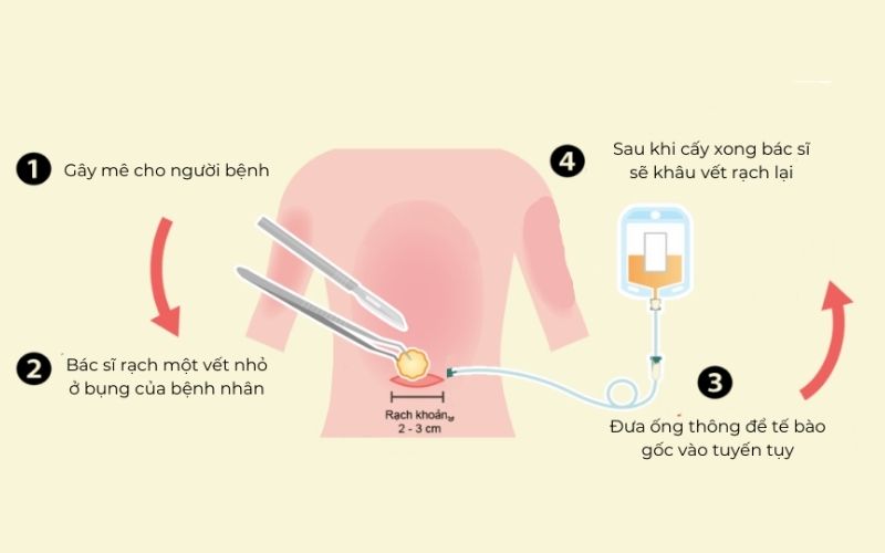 Cấy tế bào gốc vào tuyến tụy có thể cung cấp nhiều tế bào gốc hơn
