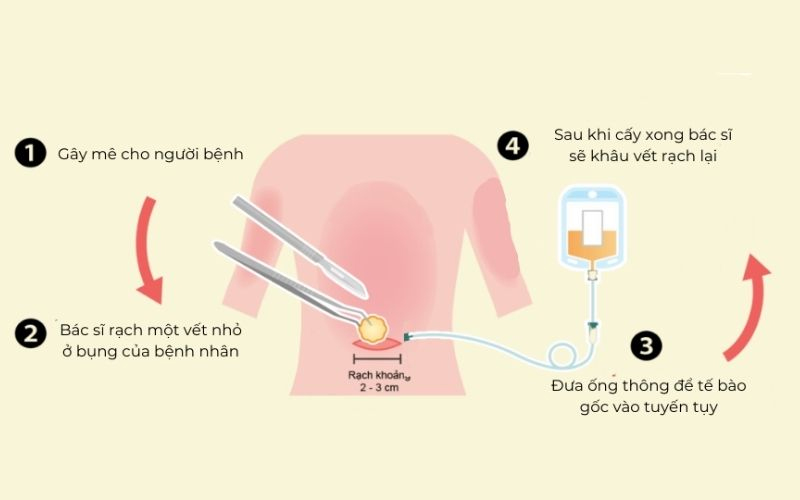 Phương pháp tiêm tế bào gốc